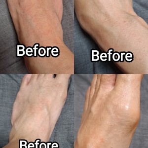 癢到跳舞, 5天療愈好方法 *